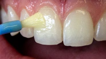Effetti indesiderati del fluoro: fluorosi dentale.